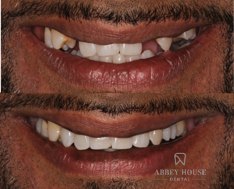 Before and After - Implants & Invisalign