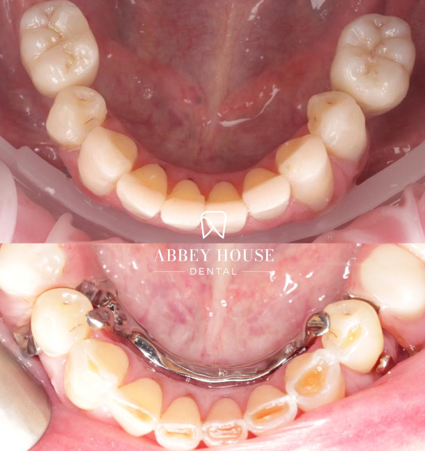 Before and After - Full Arch Comp Bonding