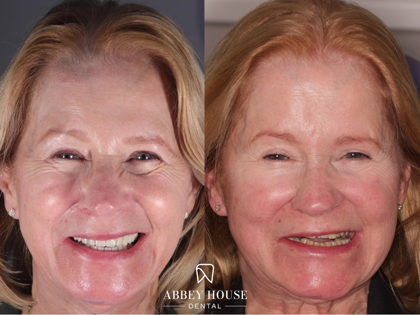 Before and After - Full Arch Comp Bonding