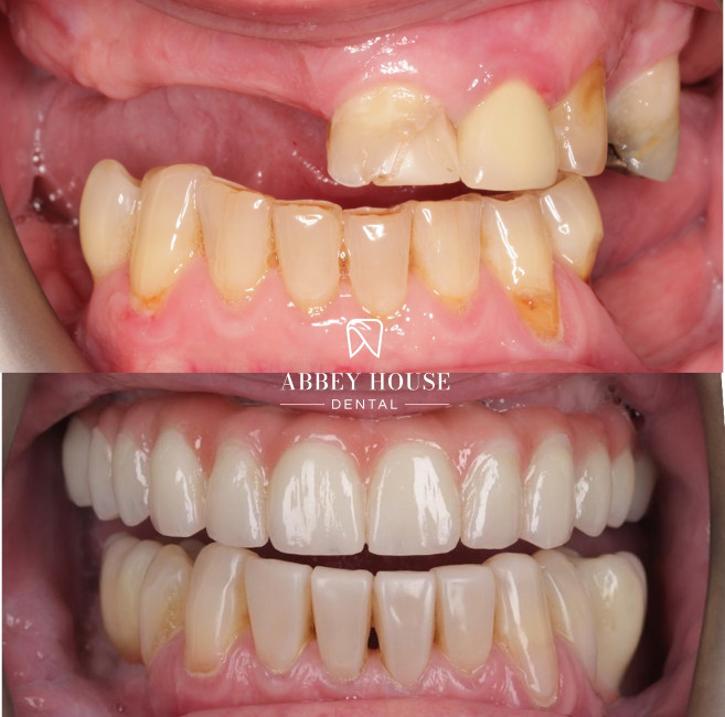 Before and After - Full Arch Comp Bonding