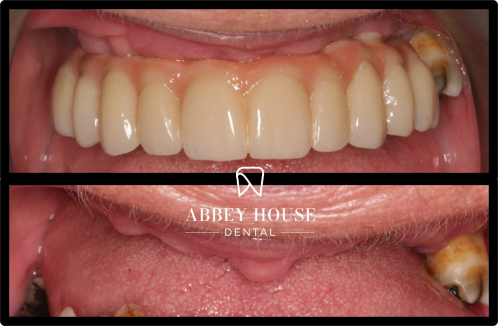 Before and After - Full Arch Implants