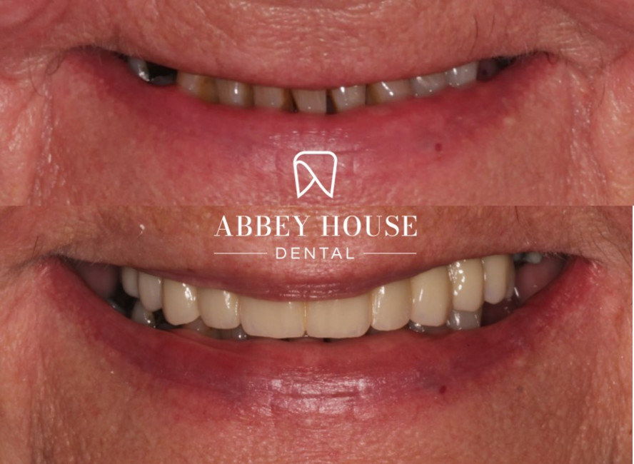 Before and After - Full Arch Implants