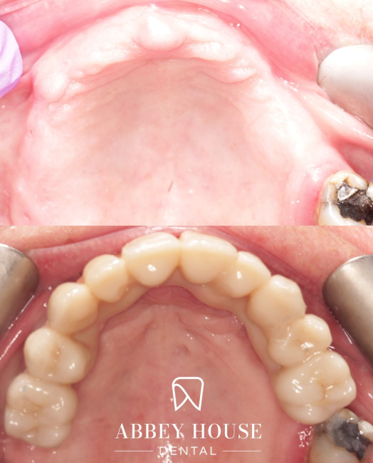 Before and After - Full Arch Implants