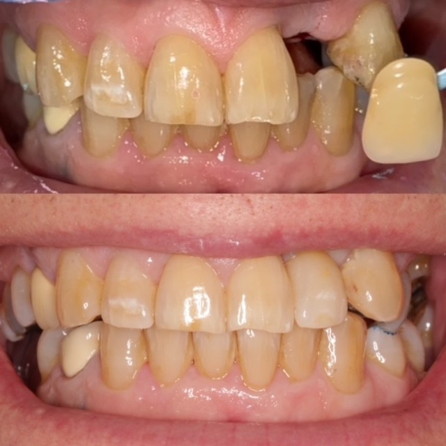Before and After - Implant