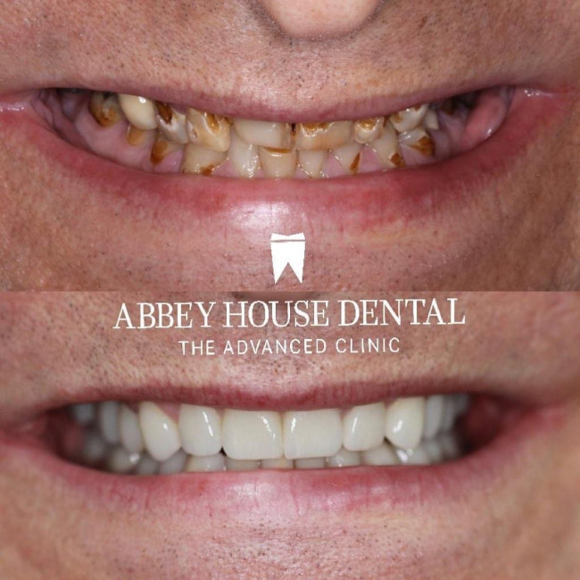 Before and After - Implant